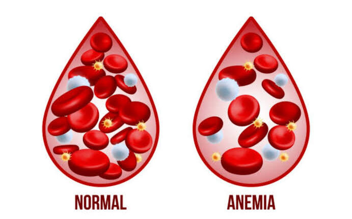 Over 72% of children under 5 suffer from anaemia in IIOJK, raising alarms